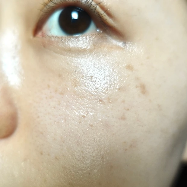 【ご当地美容】上海のヨセミテクリニックでM22(IPL治療)を受けてみた！6回コースでシミそばかすに効果あり！_3_1