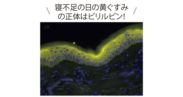 寝不足の日の黄ぐすみの正体はビリルビン！