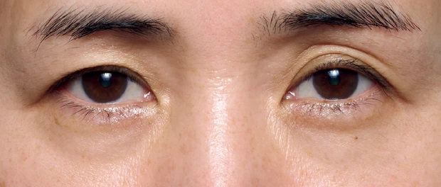 黒ぐま×たるみぐまタイプのくまカバー&涙袋メイクのテクニック ビフォー