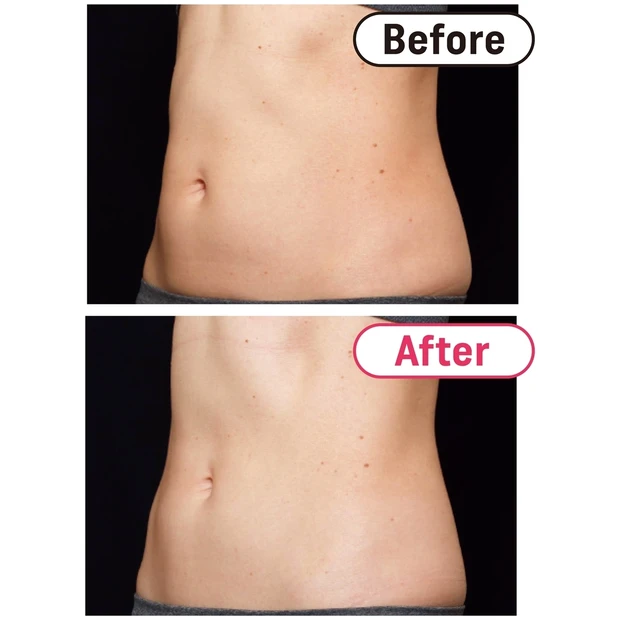 夏までにぽっこりお腹をなかったことに!? お腹痩せが叶う話題の美容医療を…