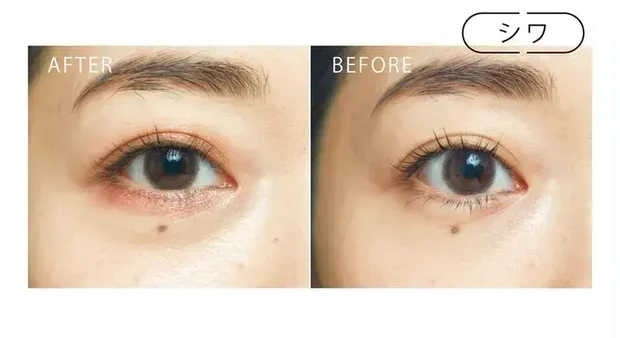 シワ BEFORE/AFTER