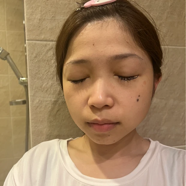 【渡韓レポ】韓国でハイフとエラボトックスして来ました（月１回×２）！！痛みは？効果は？体験談をレポートします💓小顔になりたいか方必見です！！明洞のTHE CLIM Clinicに行ってきたよ_2_1