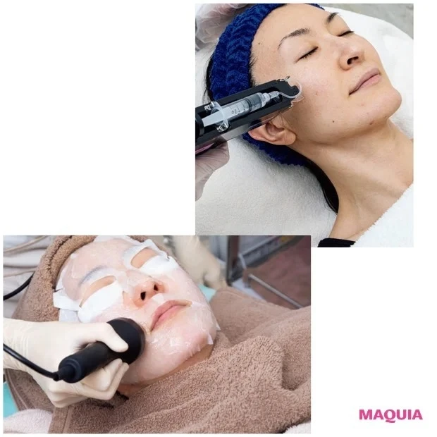 毛穴ケアに限界を感じたらクリニックへ! ライトなものから本格ケアまで毛穴施術をご紹介