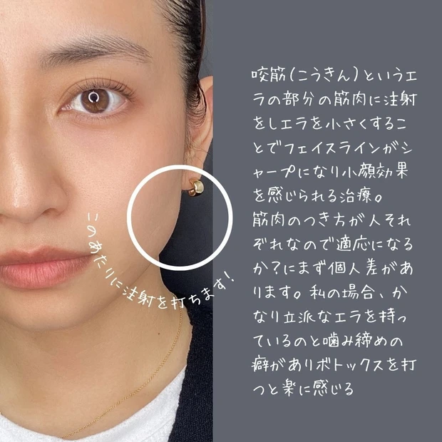 エラボトックス