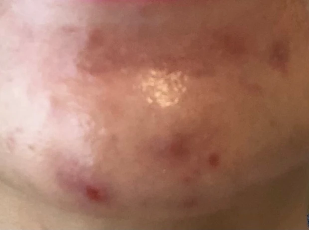 美容ナース直伝！！【ニキビ出来たら使って欲しい♡ニキビ撃退アイテム】_3