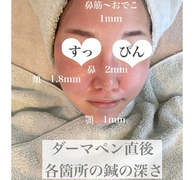 美容医療レポ【ダーマペン・ベルベットスキン】_2
