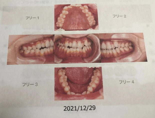 【デンタルケア】歯のクリーニング「エアーフロー」がすごい!年末年始は白い歯で過ごそう_2