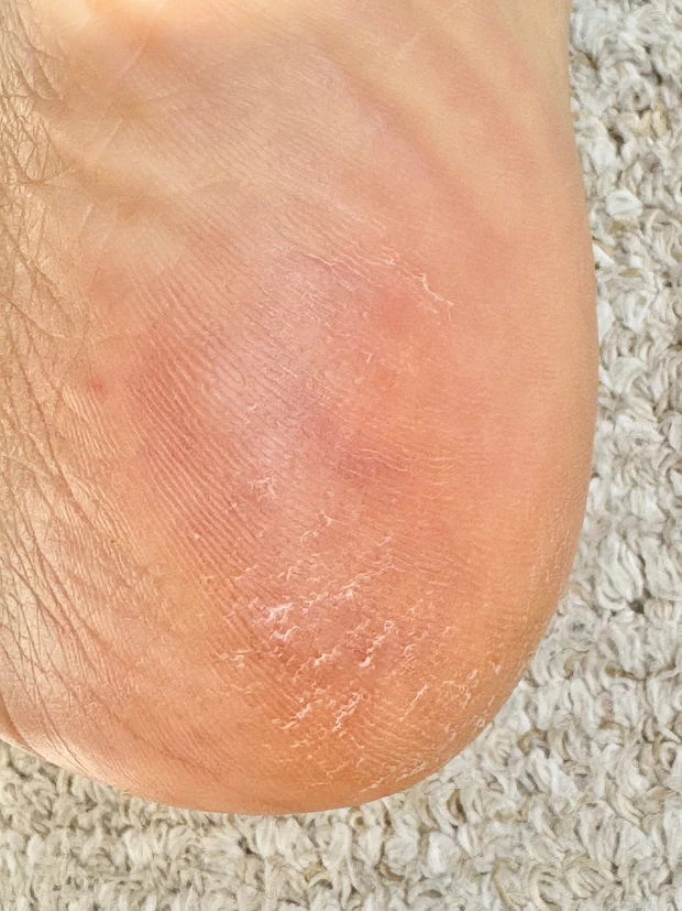 ガサガサかかと　かかと　角質ケア