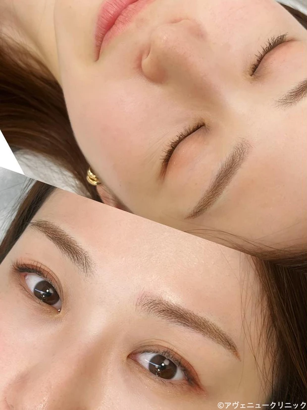 アヴェニュークリニック アートメイク アイブロウ症例写真