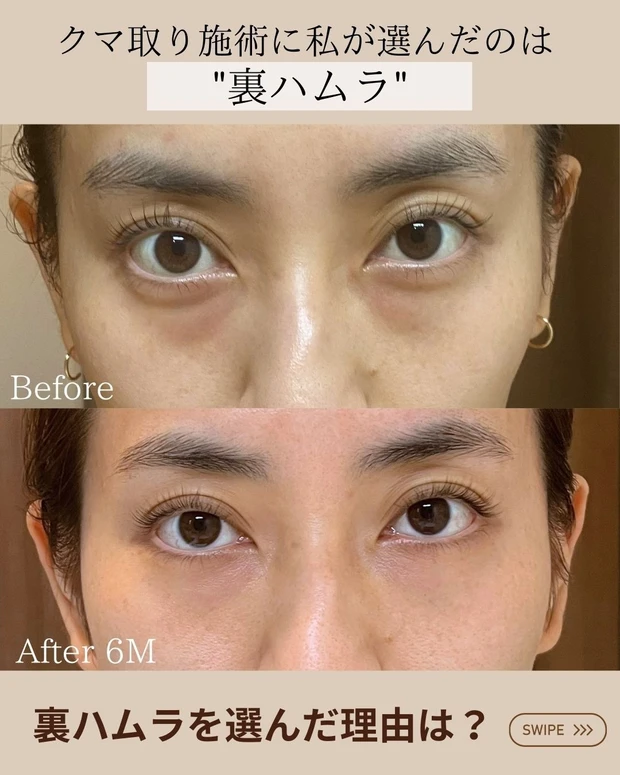 裏ハムラ_目の下のクマ_クマ取り_AYAMI