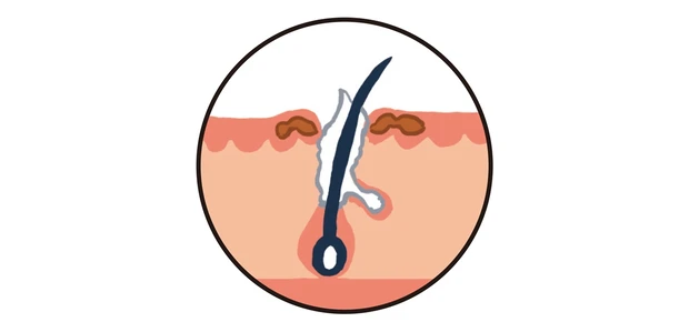 ②「色素沈着」が原因の黒ずみ毛穴