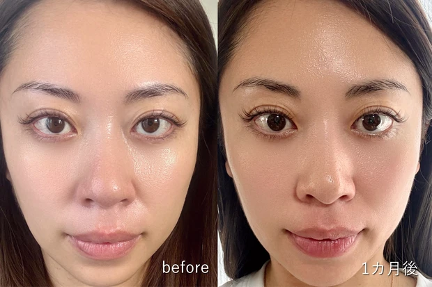 【体験レポ】やってよかった！初心者におすすめ！ナチュラルに仕上がる「糸リフト（スレッドリフト）」経過・クリニック紹介_8