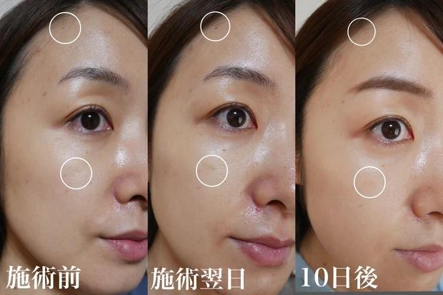 【美容医療】シミ対策に4回目のフォトフェイシャル＊施術内容・効果・痛み・ダウンタイムについてくわしくレポートします！_4