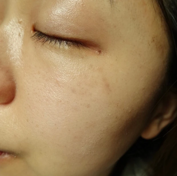 【ご当地美容】上海のヨセミテクリニックでM22(IPL治療)を受けてみた！6回コースでシミそばかすに効果あり！_7_2