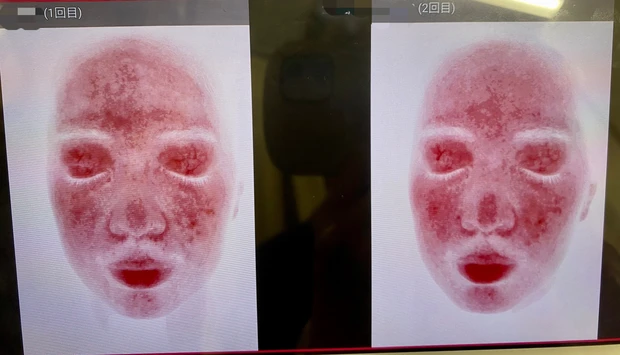 【30代で美容医療デビュー2】カスタマイズレーザー治療[２回目］施術1ヶ月後の結果レポート_5