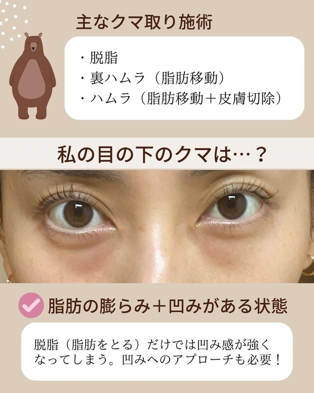 裏ハムラ_目の下のクマ_クマ取り_AYAMI