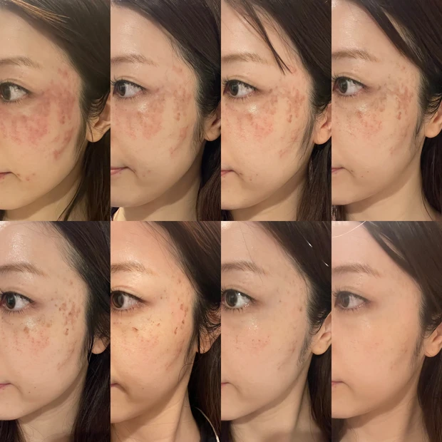 シミ取り　ルビーレーザー