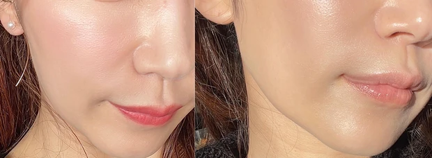 美容課金 小顔矯正