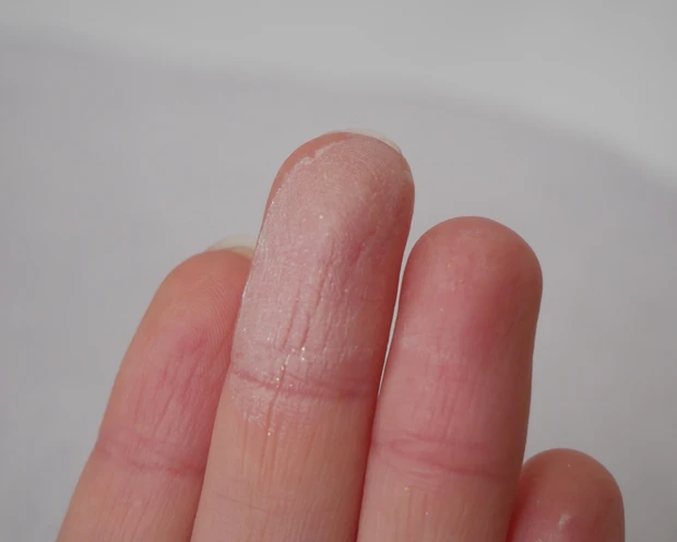 ポアレスフィクサー