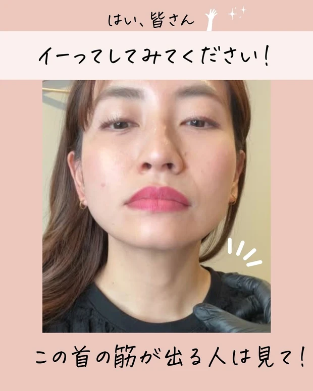 広頚筋ボトックス_リフトアップボトックス