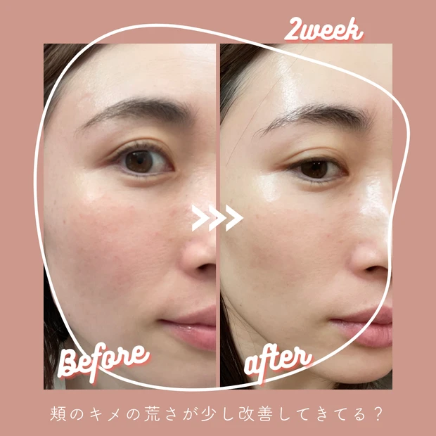 VT COSMETICS「シカレチA エッセンス0.1」ビフォーアフター