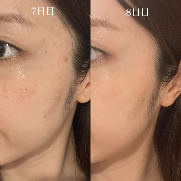 ルビーレーザー　DT