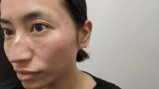 ダーマペン４施術直後（頬、目周り）