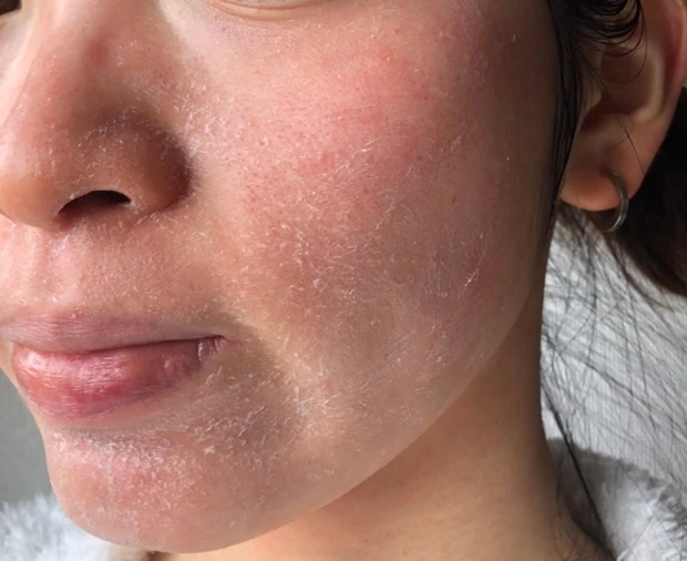 【ゼオスキンヘルス】剥け剥け生活3ヶ月終了しました！~体験報告~_5_1