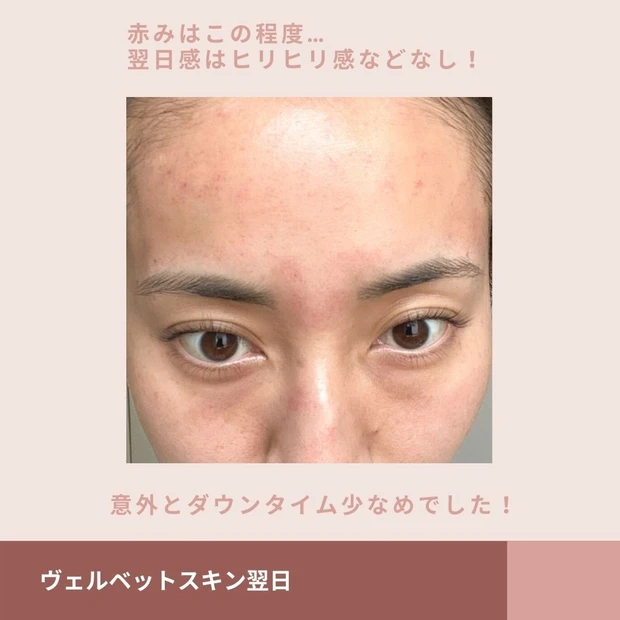 ヴェルベットスキンのダウンタイム