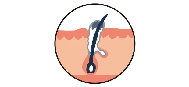 ①「皮脂酸化」が原因の黒ずみ毛穴