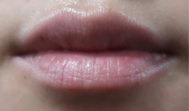 美容皮膚科施術「ピコスポット」_5_2