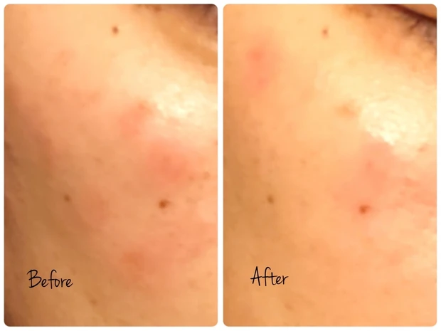 肌荒れに！人気のイハダから美白もできる化粧水と乳液が登場！2週間使ってみました。_2