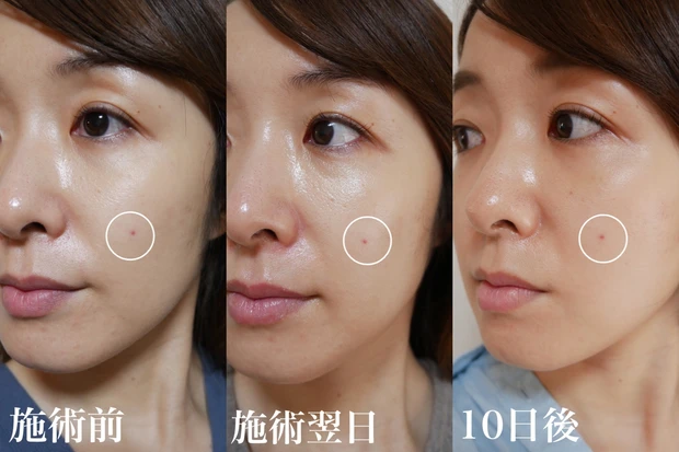 【美容医療】シミ対策に4回目のフォトフェイシャル＊施術内容・効果・痛み・ダウンタイムについてくわしくレポートします！_5