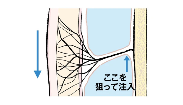 最新美容医療 ヒアルロン酸注入 リガメントを支えて補強する ビフォー