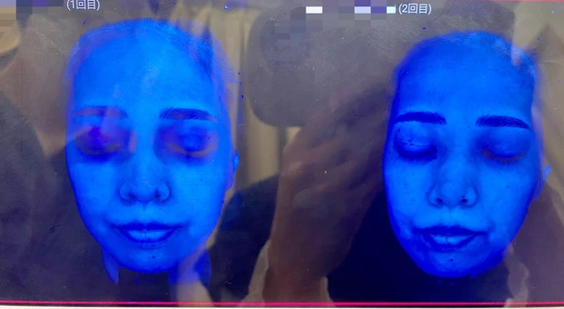 【30代で美容医療デビュー2】カスタマイズレーザー治療[２回目］施術1ヶ月後の結果レポート_4