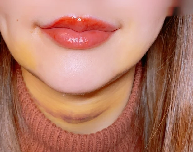 【顎下脂肪吸引受けてきました②】手術前〜1週間の経過記録ダウンタイムまとめ_2