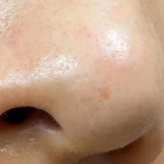 スポットシミケアを２種比較。できちゃったシミにも効くの？答えはYES!!_3_1