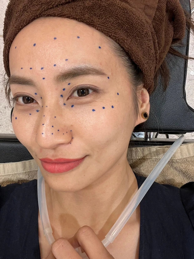 マイクロボトックス_ボトックス_美容皮膚科_真山綾美