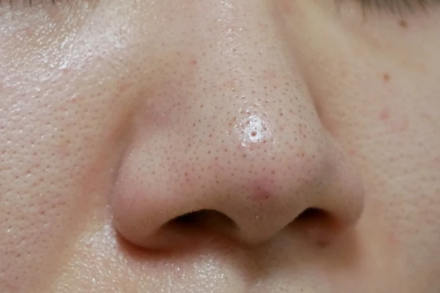 【before/after】たった14日で毛穴撲滅？イプサのポアスキンステップスを実際に使ってみました！_10_3