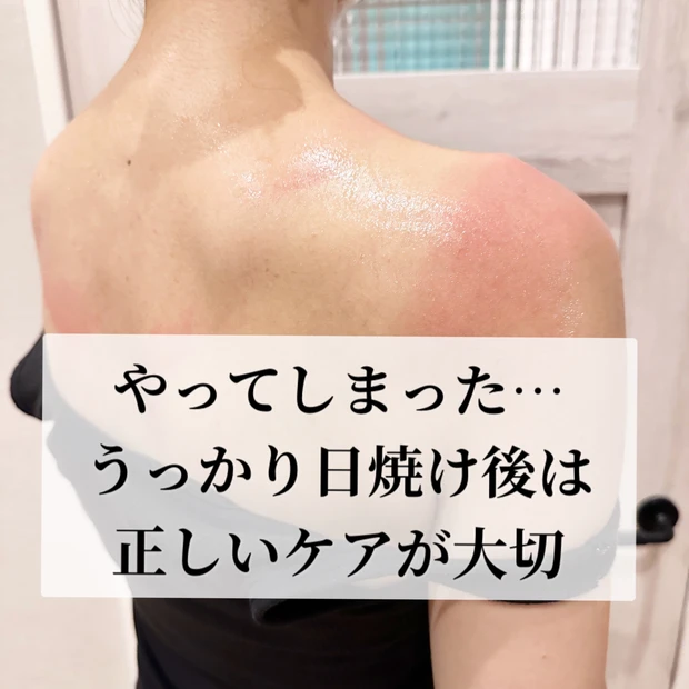 うっかり日焼け