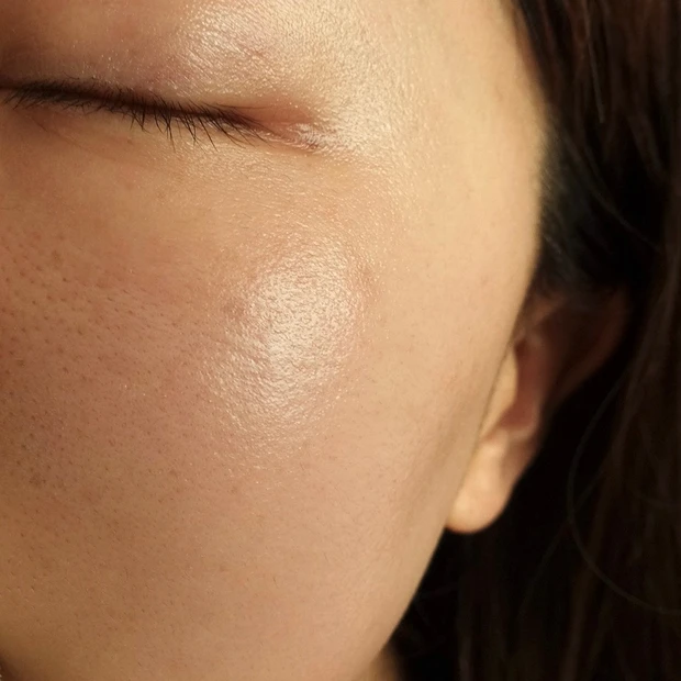 【ご当地美容】上海のヨセミテクリニックでM22(IPL治療)を受けてみた！6回コースでシミそばかすに効果あり！_8_1