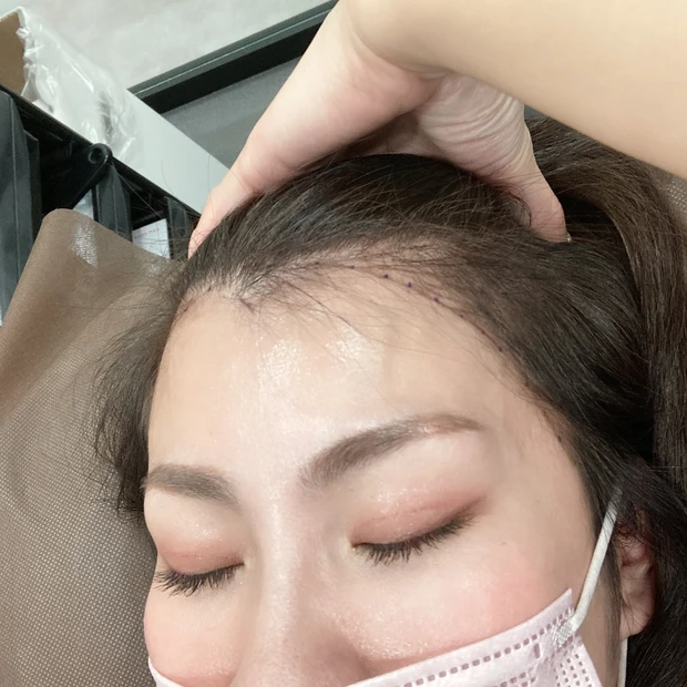 施術動画あり!ヘアラインアートメイクって知ってる?生え際のアートメイクとっても気に入ったのでレビューします!
_3_4