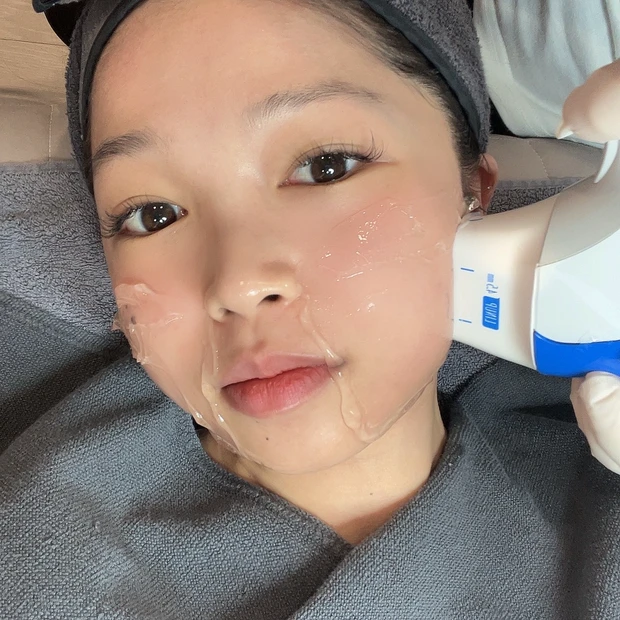 【渡韓レポ】韓国でハイフとエラボトックスして来ました（月１回×２）！！痛みは？効果は？体験談をレポートします💓小顔になりたいか方必見です！！明洞のTHE CLIM Clinicに行ってきたよ_6_2