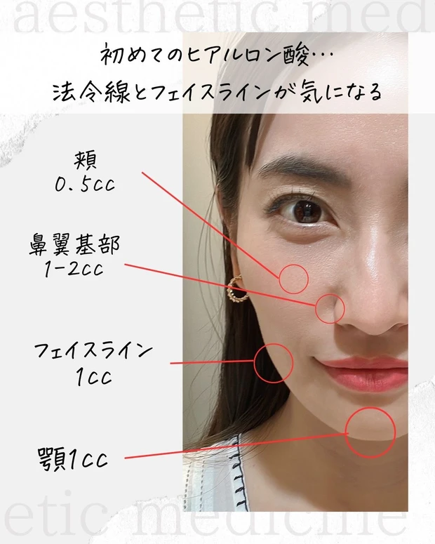 AYAMI_ヒアルロン酸注入_美容医療_真山綾美