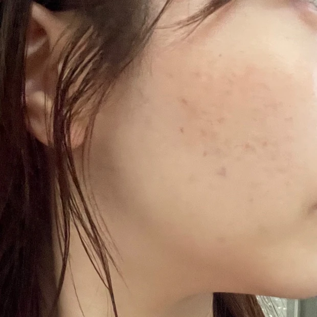 ジュベルック　手打ち　ダウンタイム