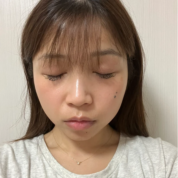 【渡韓レポ】韓国でハイフとエラボトックスして来ました（月１回×２）！！痛みは？効果は？体験談をレポートします💓小顔になりたいか方必見です！！明洞のTHE CLIM Clinicに行ってきたよ_4_2