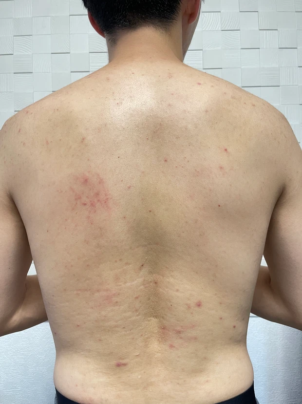 【リファファインバブル S】を使ったら、その後どうなった?パパの背中ニキビ激減。〜4ヶ月後〜_2_1