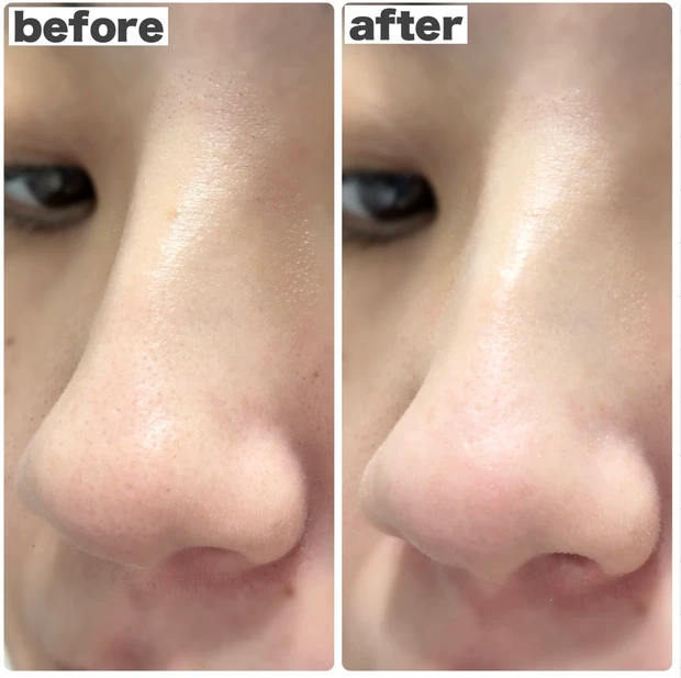 ビオレ おうちdeエステ ディープクレイ洗顔 小鼻に使用したビフォーアフター