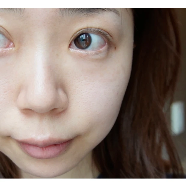 【韓国美容医療②】シロアムクリニックで肌管理！ドクターおまかせコースでポテンツァ＆シュリンク体験レポ。_6_2