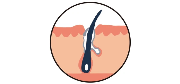 ③「産毛」が原因の黒ずみ毛穴